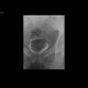 Perineal fistula, communicating with rectum: RF - Fluoroscopy